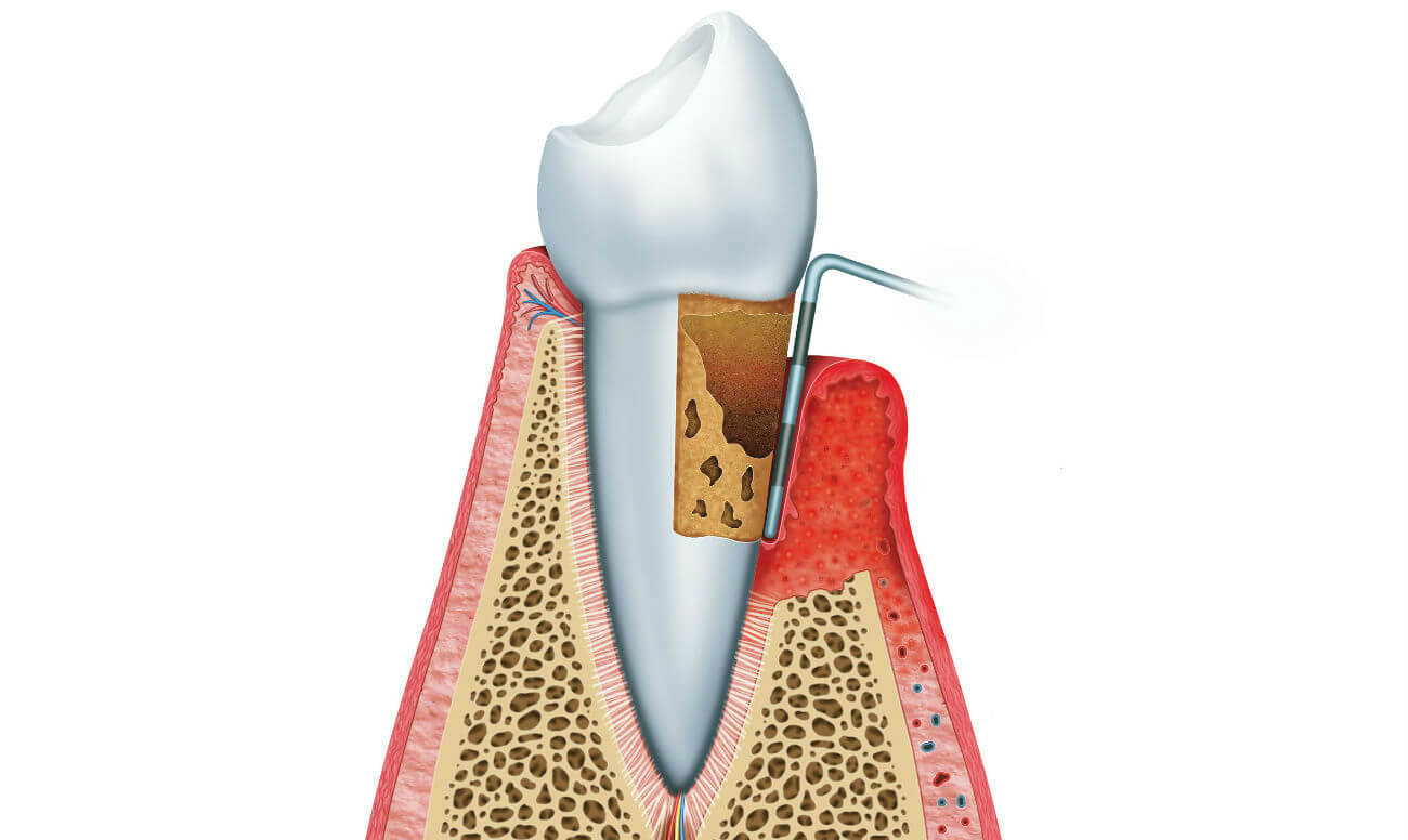 Влияние стоматологических заболеваний на организм