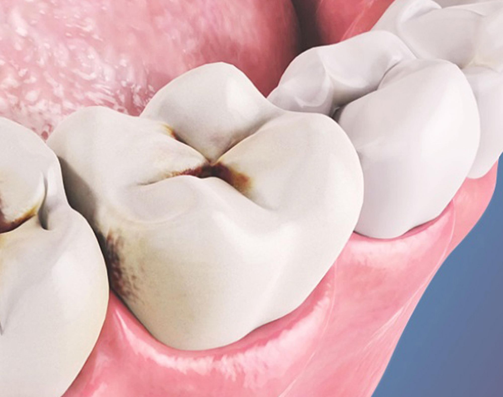 Что такое кариес зубов?