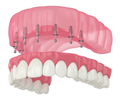 Имплантация зубов All-On-6
