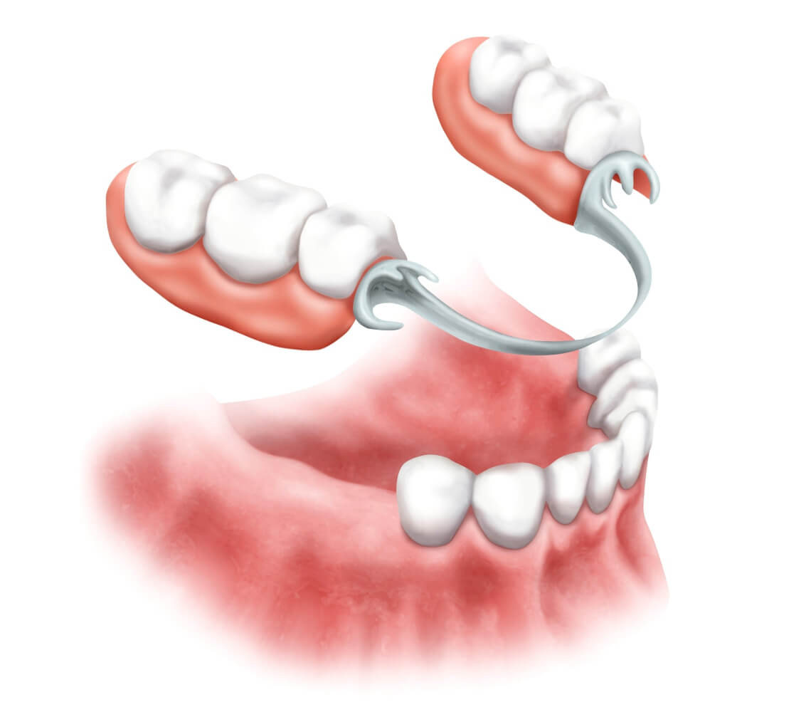 Частичный зубной протез на верхнюю челюсть