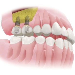 Особенности имплантации двух зубов