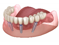 Имплантация зубов All on 4